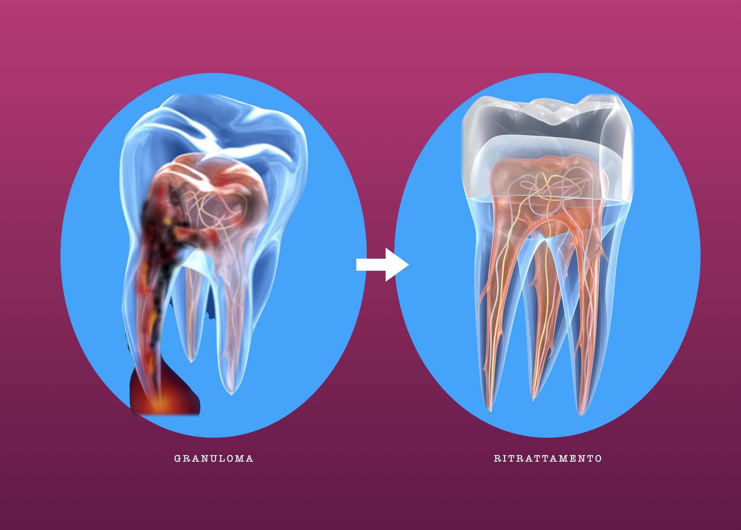 endodonzia blocco ritrattamento