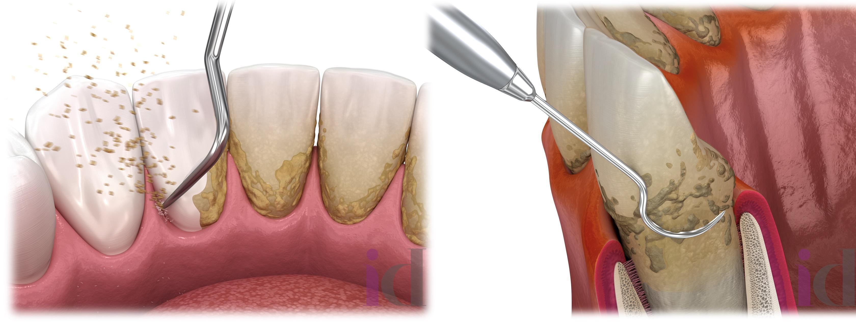 parodontologia blocco quale tecniche 